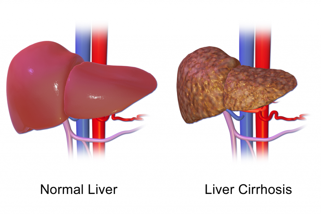 Liver_Cirrhosis